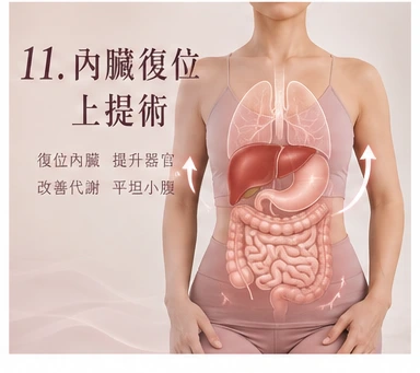 內臟復位上提術